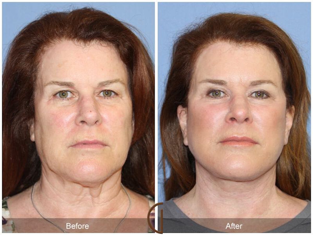 Neck Lift Before & After Gallery - Patient 140843 - Image 2