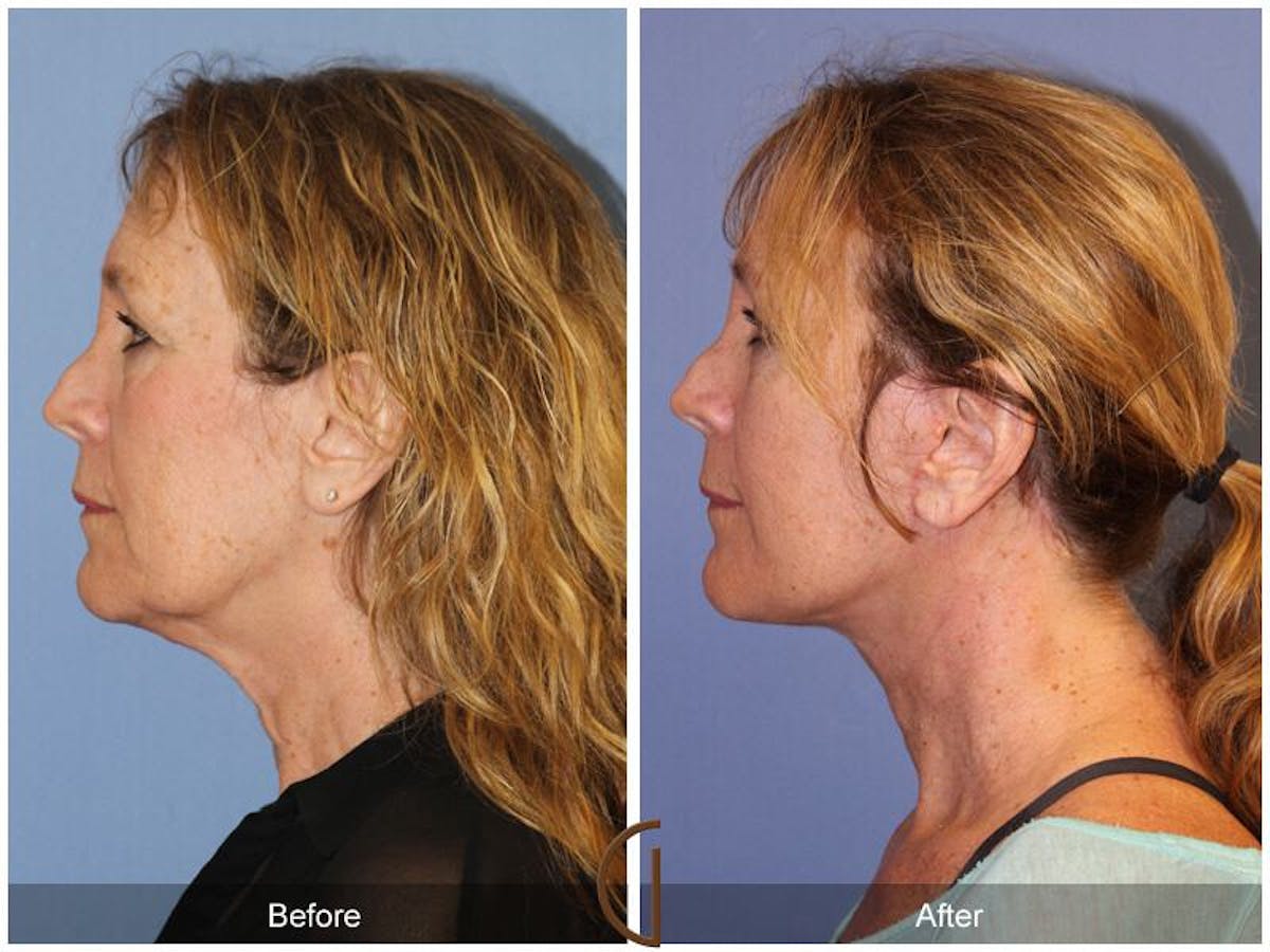 Facelift 50s Before & After Gallery - Patient 173090 - Image 1