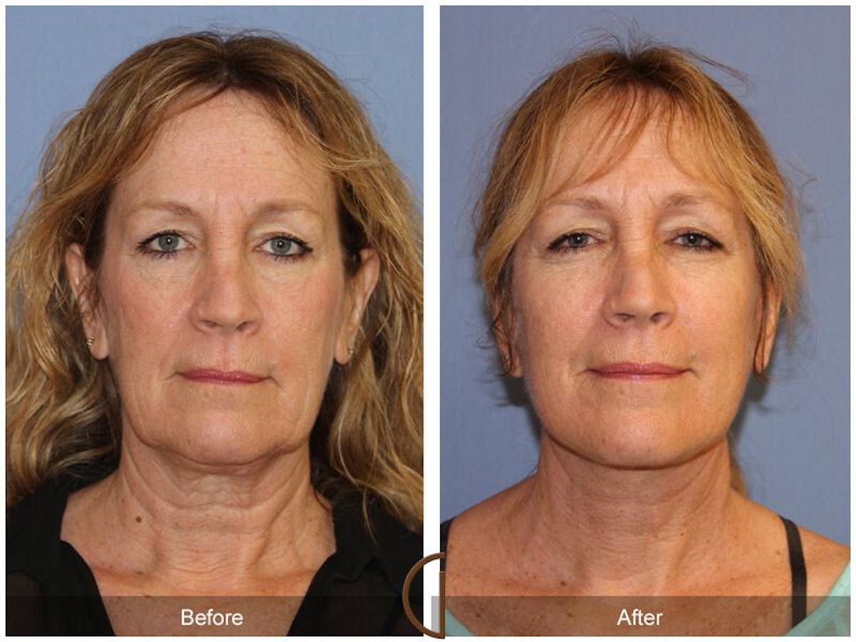 Facelift 50s Before & After Gallery - Patient 173090 - Image 2