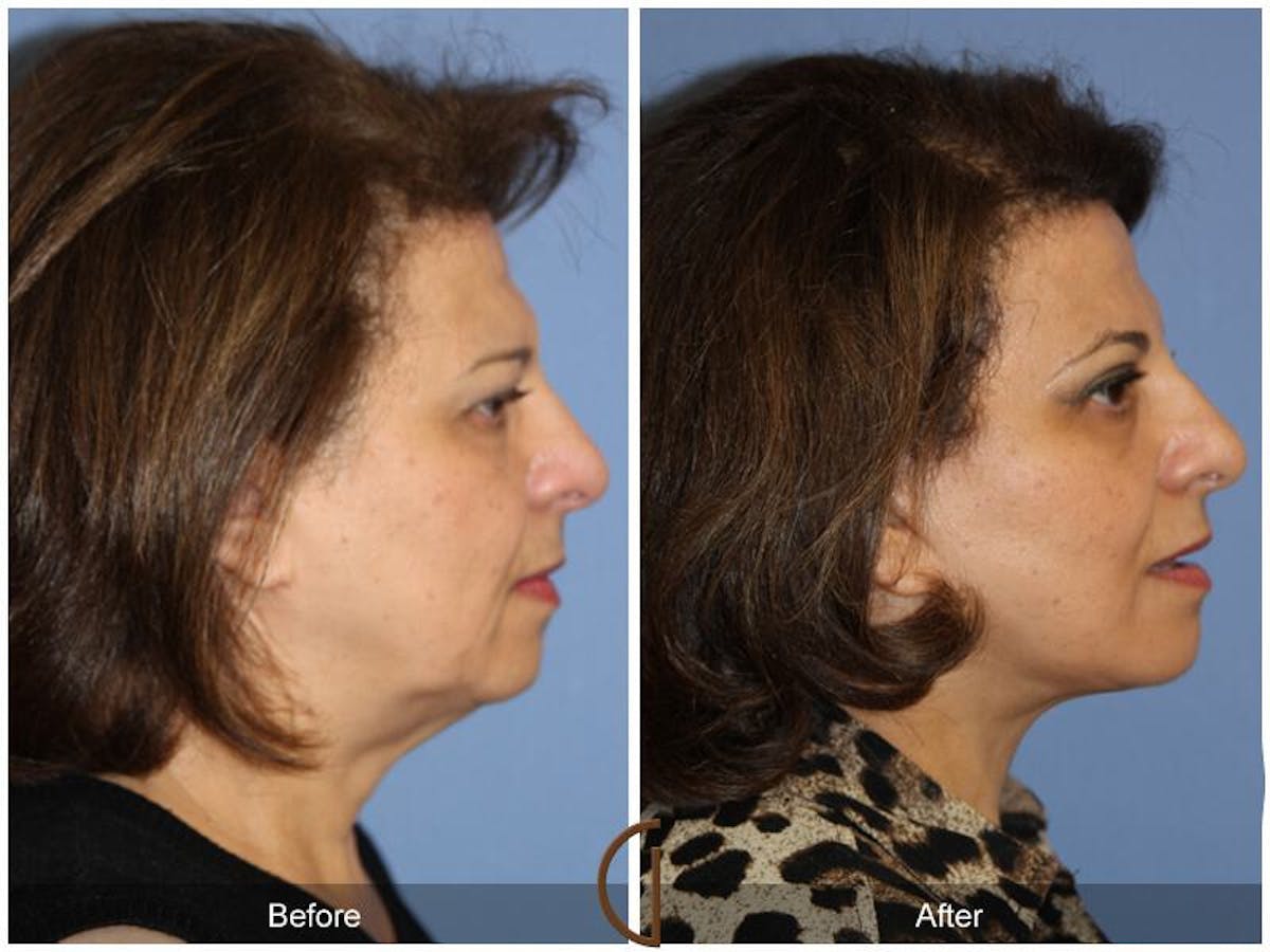 Facelift 60s Before & After Gallery - Patient 404310 - Image 3