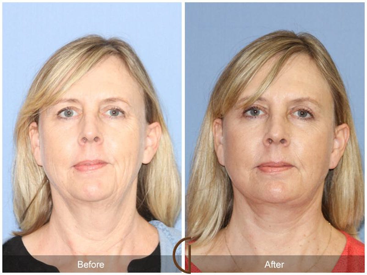 Facelift 50s Before & After Gallery - Patient 361155 - Image 2