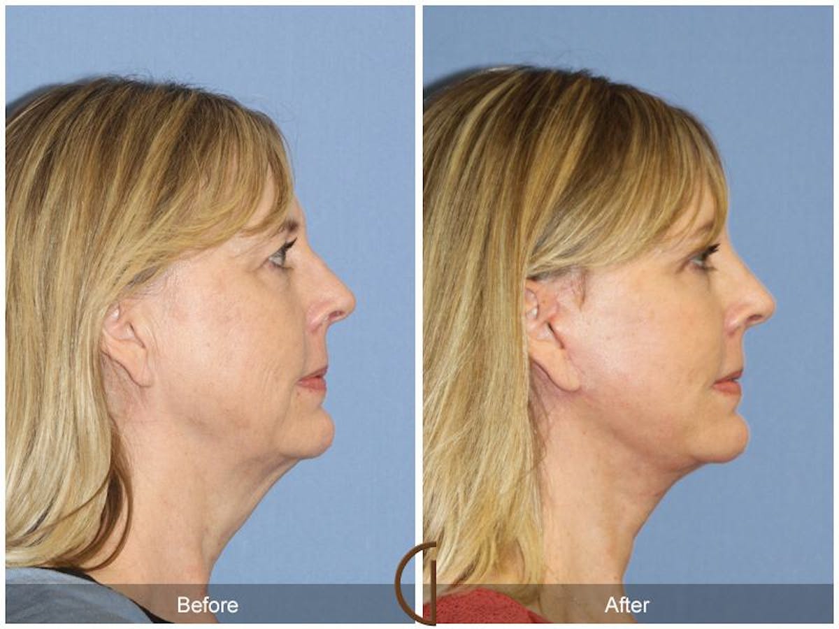 Facelift 50s Before & After Gallery - Patient 361155 - Image 3