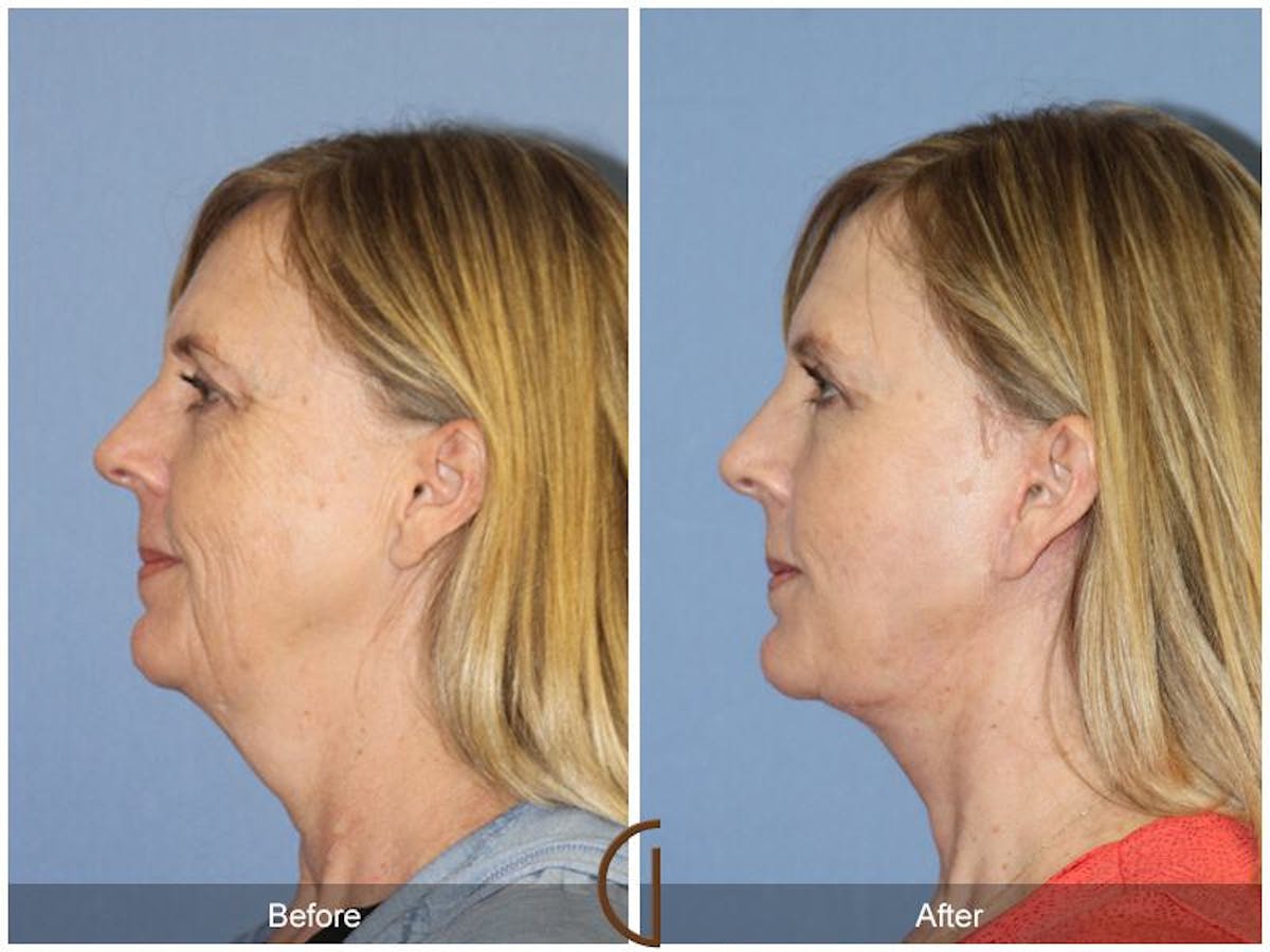 Facelift 50s Before & After Gallery - Patient 361155 - Image 1