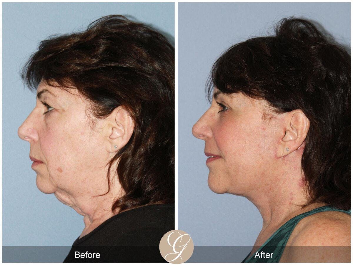 Facelift 60s Before & After Gallery - Patient 395680 - Image 1