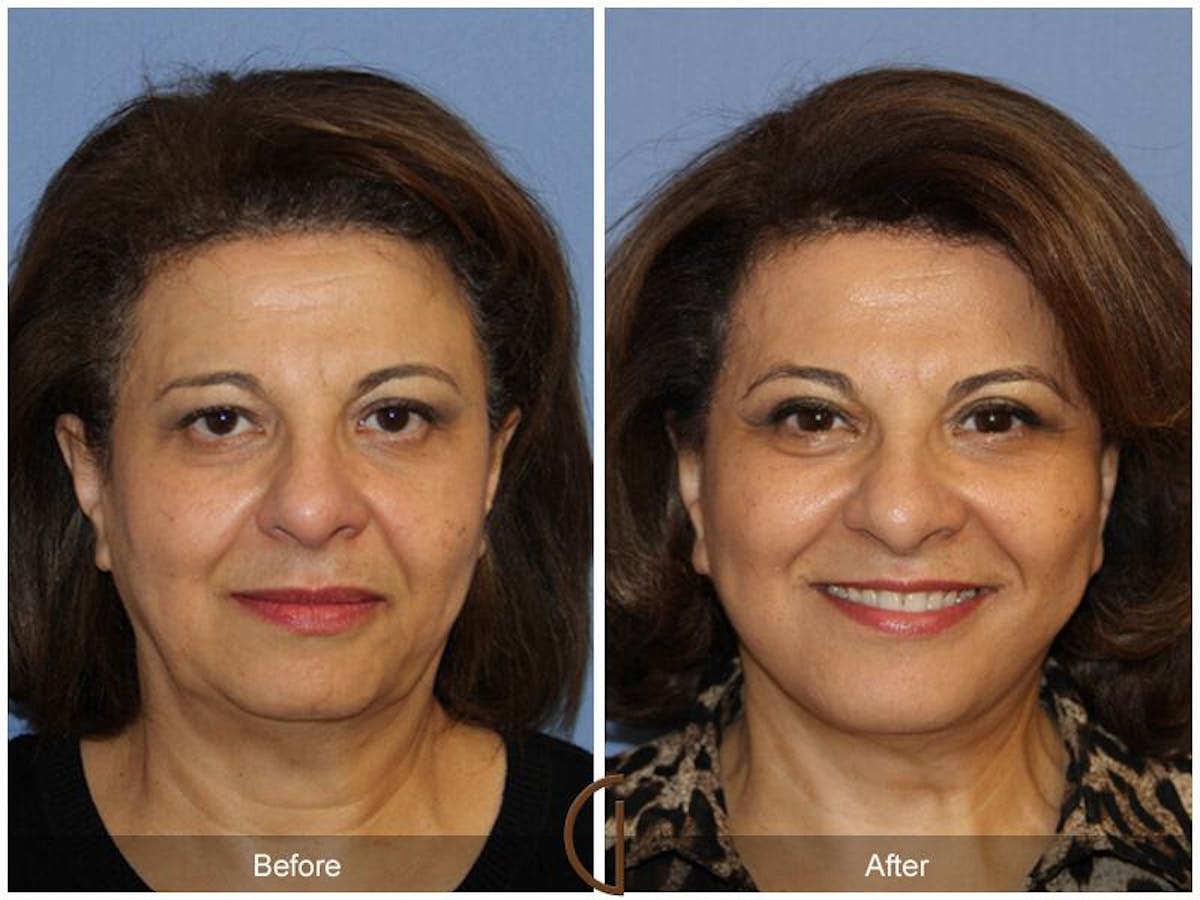 Facelift 60s Before & After Gallery - Patient 404310 - Image 2