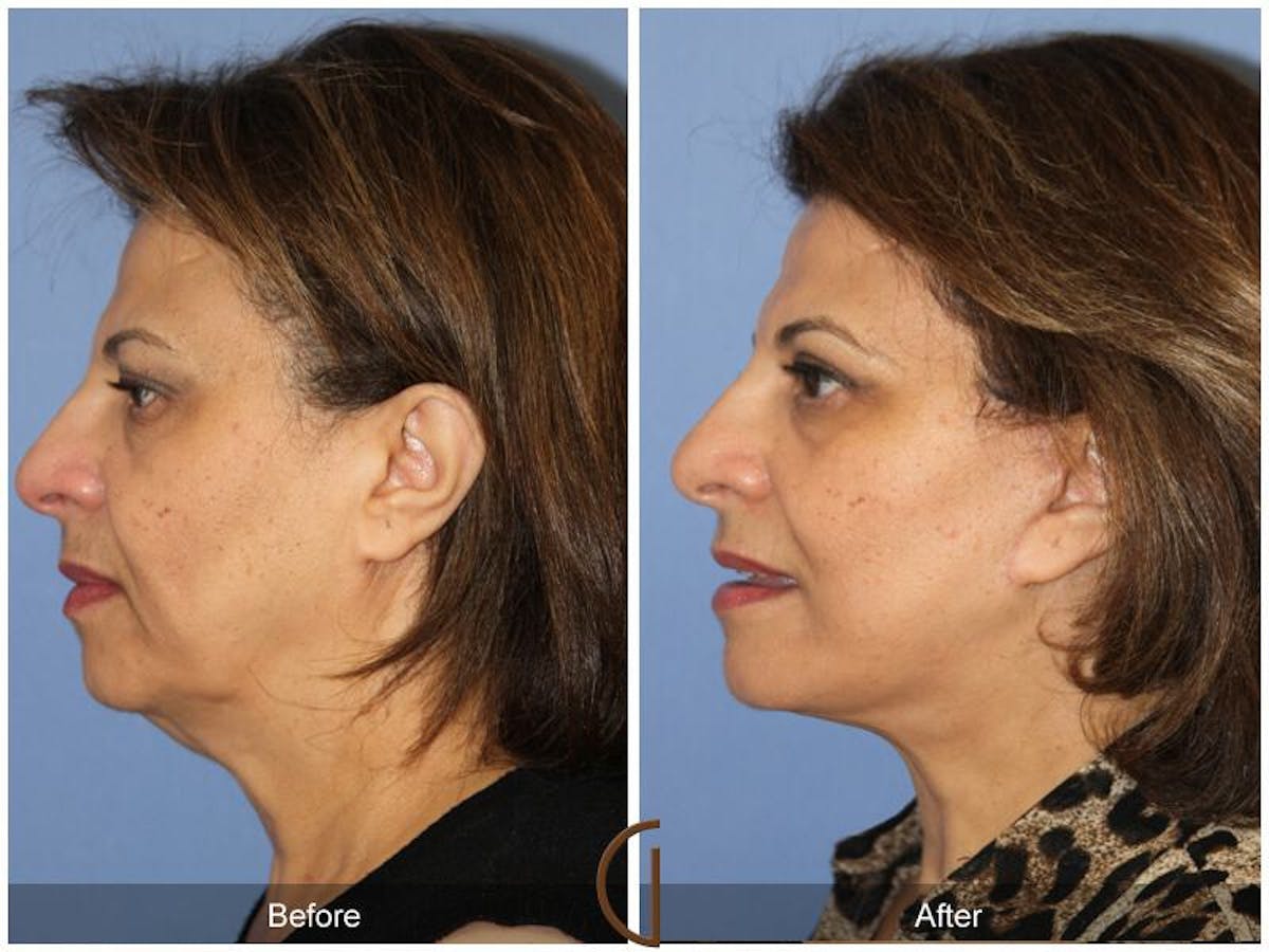 Facelift 60s Before & After Gallery - Patient 404310 - Image 1