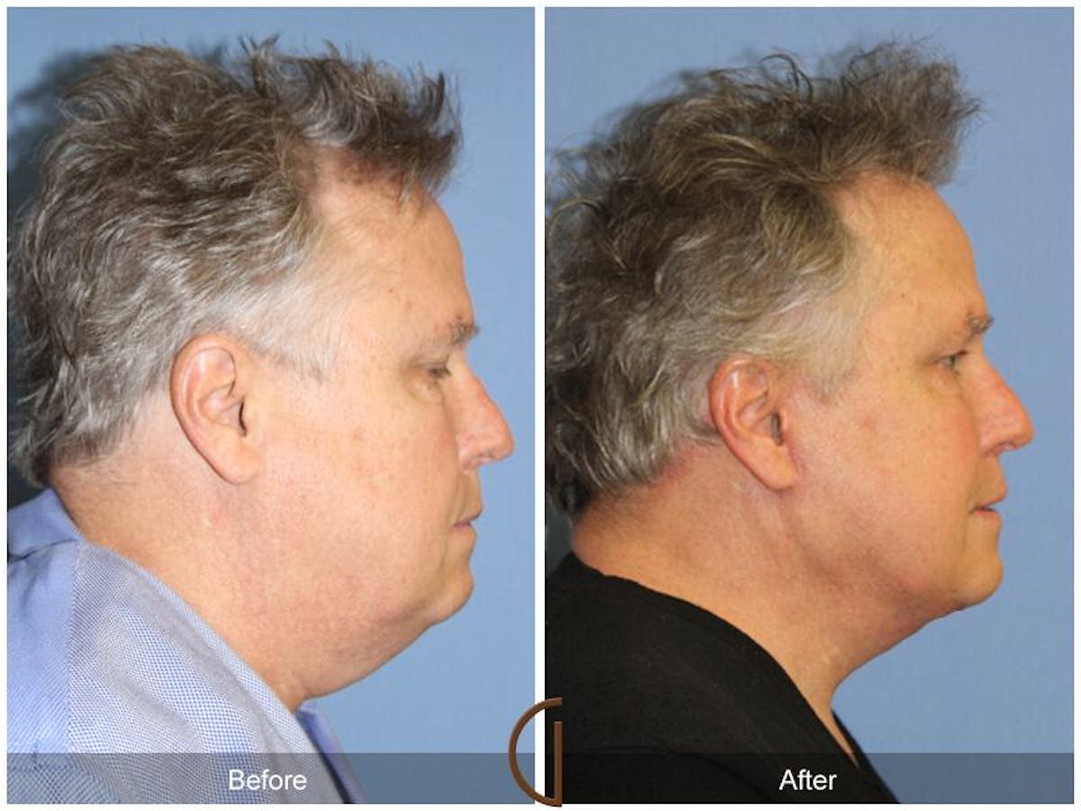 Neck Lift Before & After Gallery - Patient 852987 - Image 3