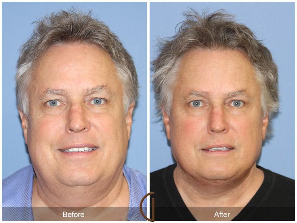 Neck Lift Before & After Gallery - Patient 852987 - Image 2