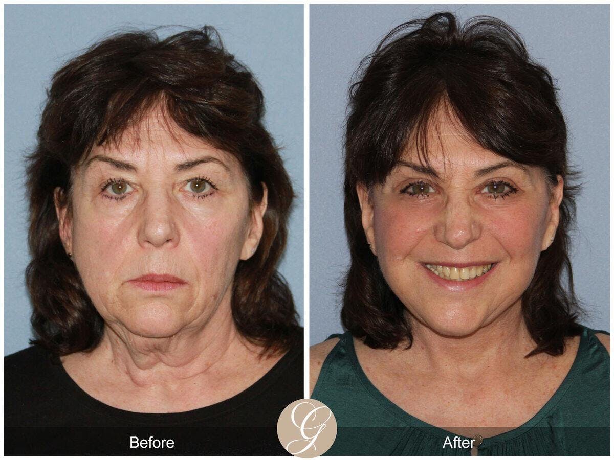 Facelift 60s Before & After Gallery - Patient 395680 - Image 2