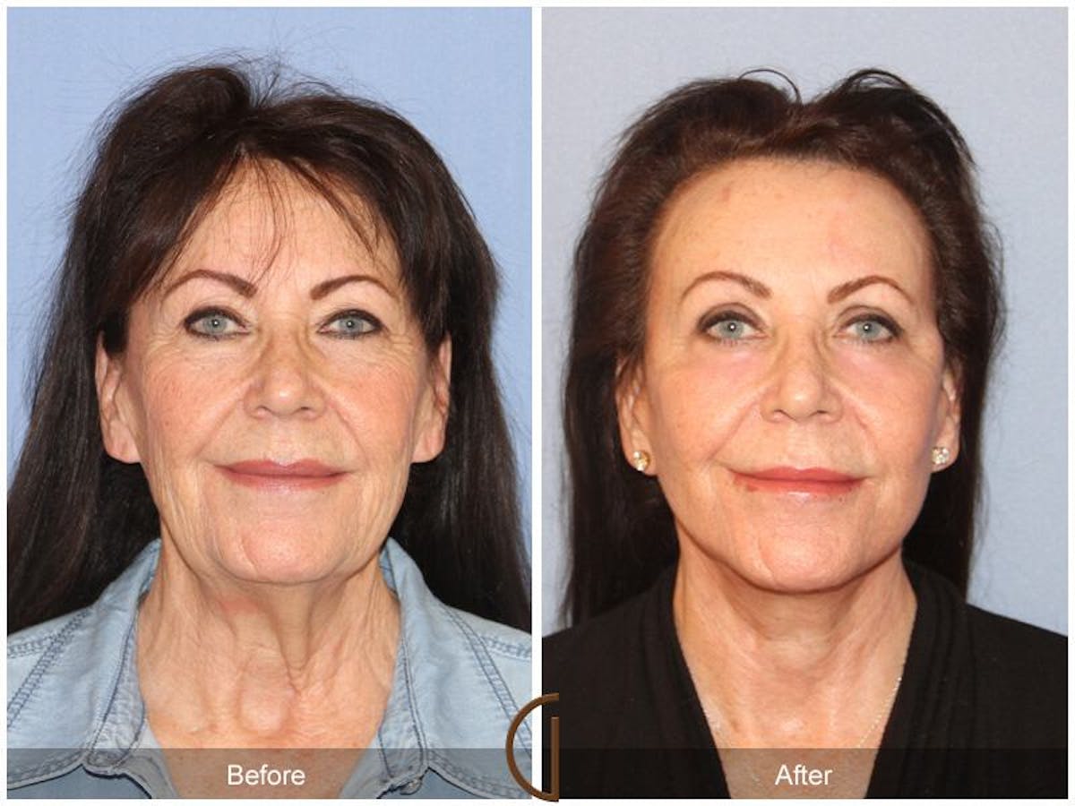 Facelift 70s Before & After Gallery - Patient 323583 - Image 2