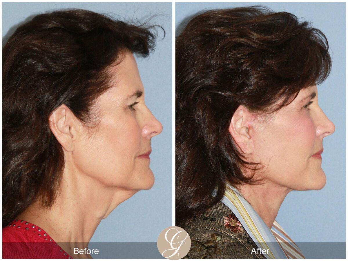 Facelift 60s Before & After Gallery - Patient 208321 - Image 3