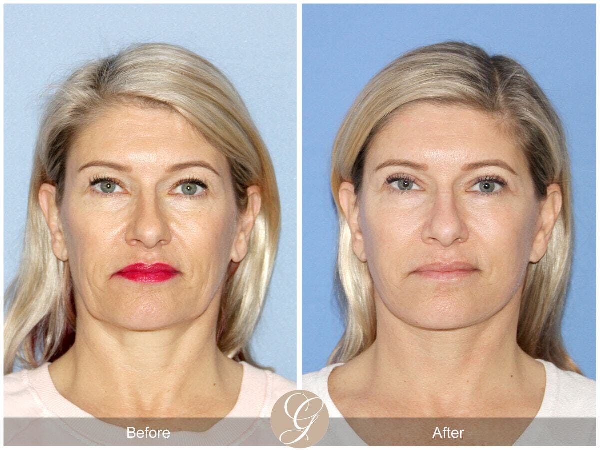 Facelift 50s Before & After Gallery - Patient 368727 - Image 2