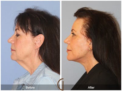 Neck Lift Before & After Gallery - Patient 116450 - Image 1