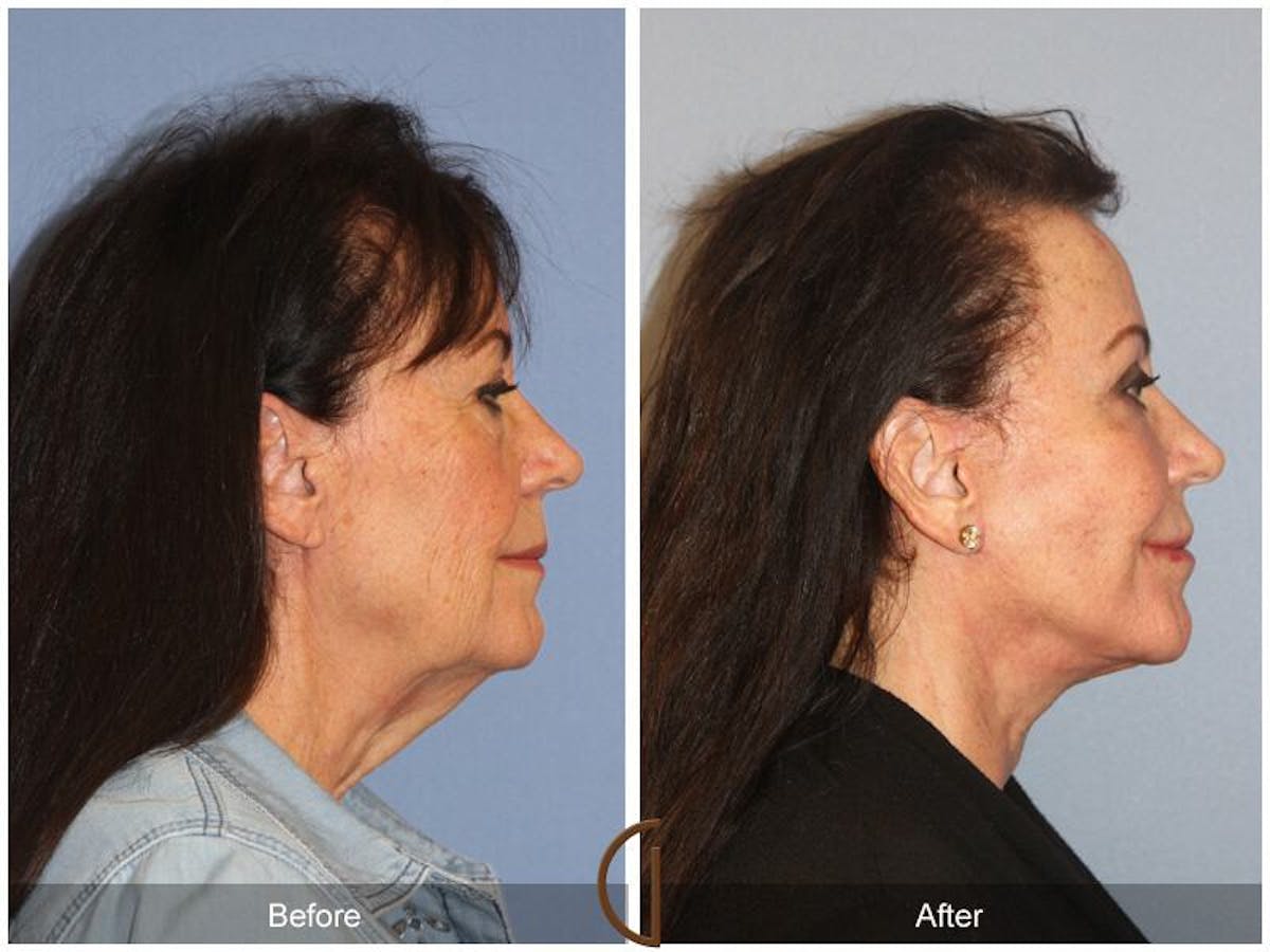 Facelift 70s Before & After Gallery - Patient 323583 - Image 3