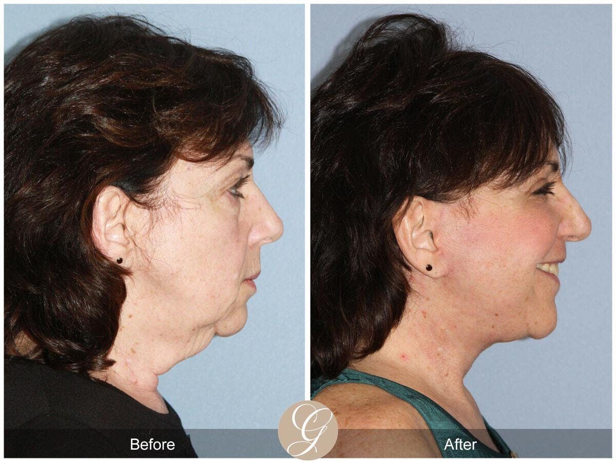 Facelift 60s Before & After Gallery - Patient 395680 - Image 3