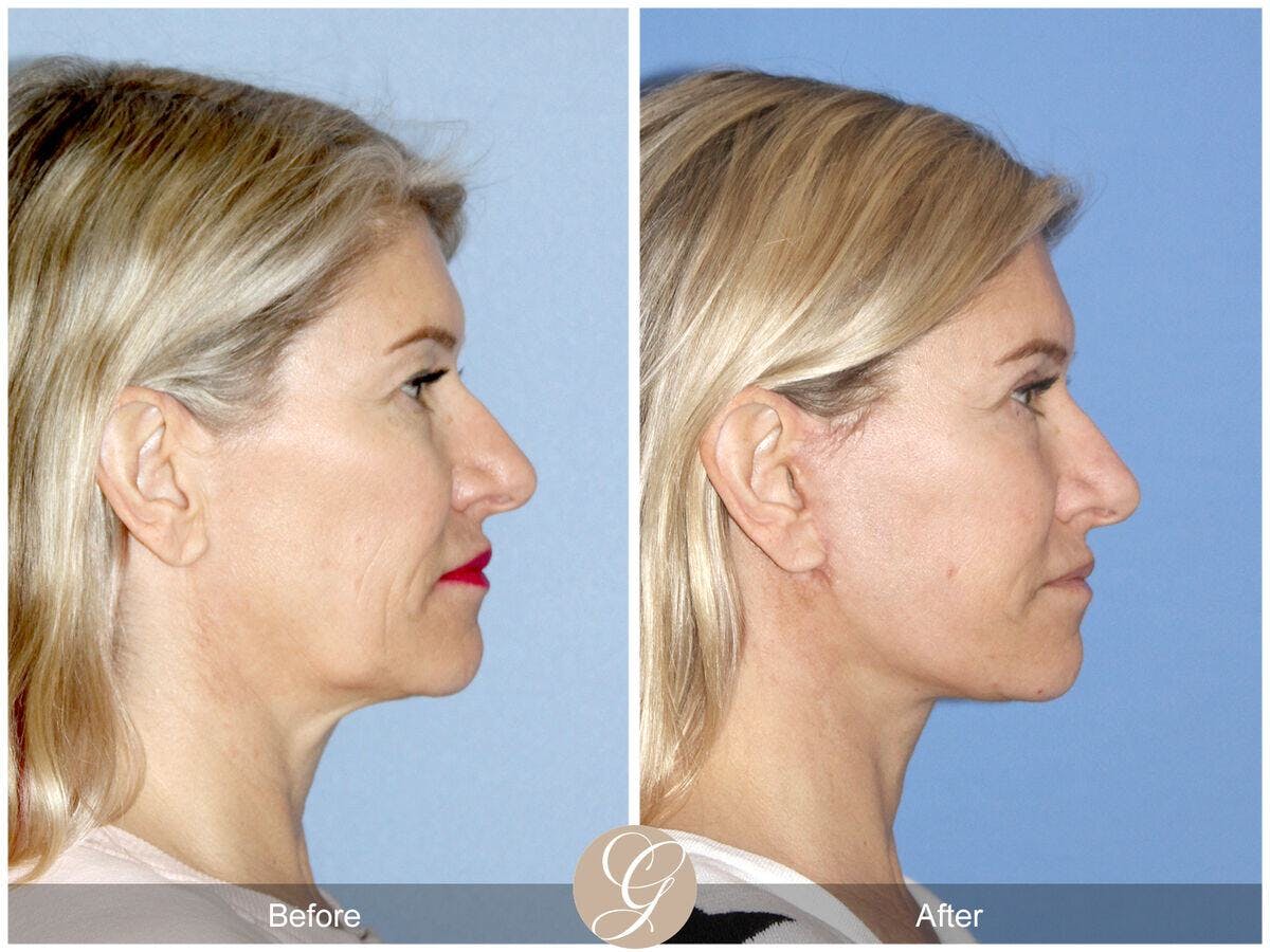 Facelift 50s Before & After Gallery - Patient 368727 - Image 3