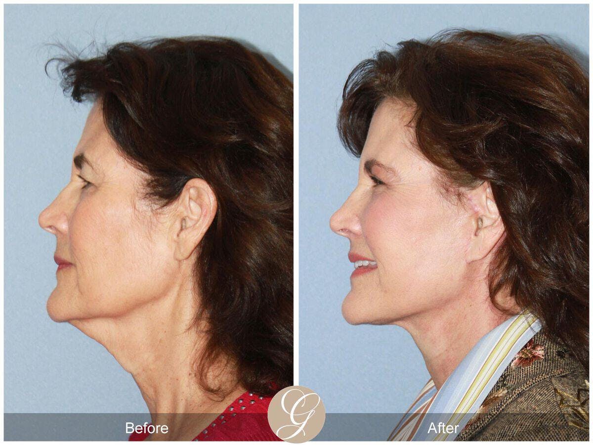 Facelift 60s Before & After Gallery - Patient 208321 - Image 1