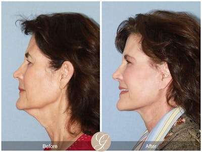 Neck Lift Before & After Gallery - Patient 800370 - Image 1