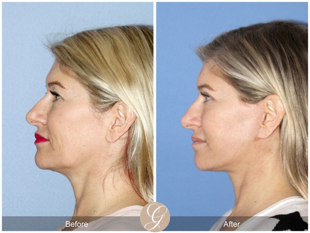 Facelift 50s Before & After Gallery - Patient 368727 - Image 1