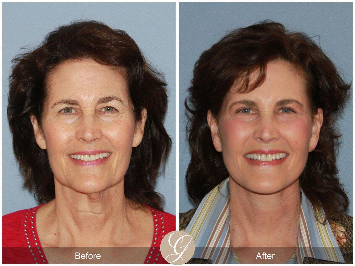 Facelift 60s Before & After Gallery - Patient 208321 - Image 2
