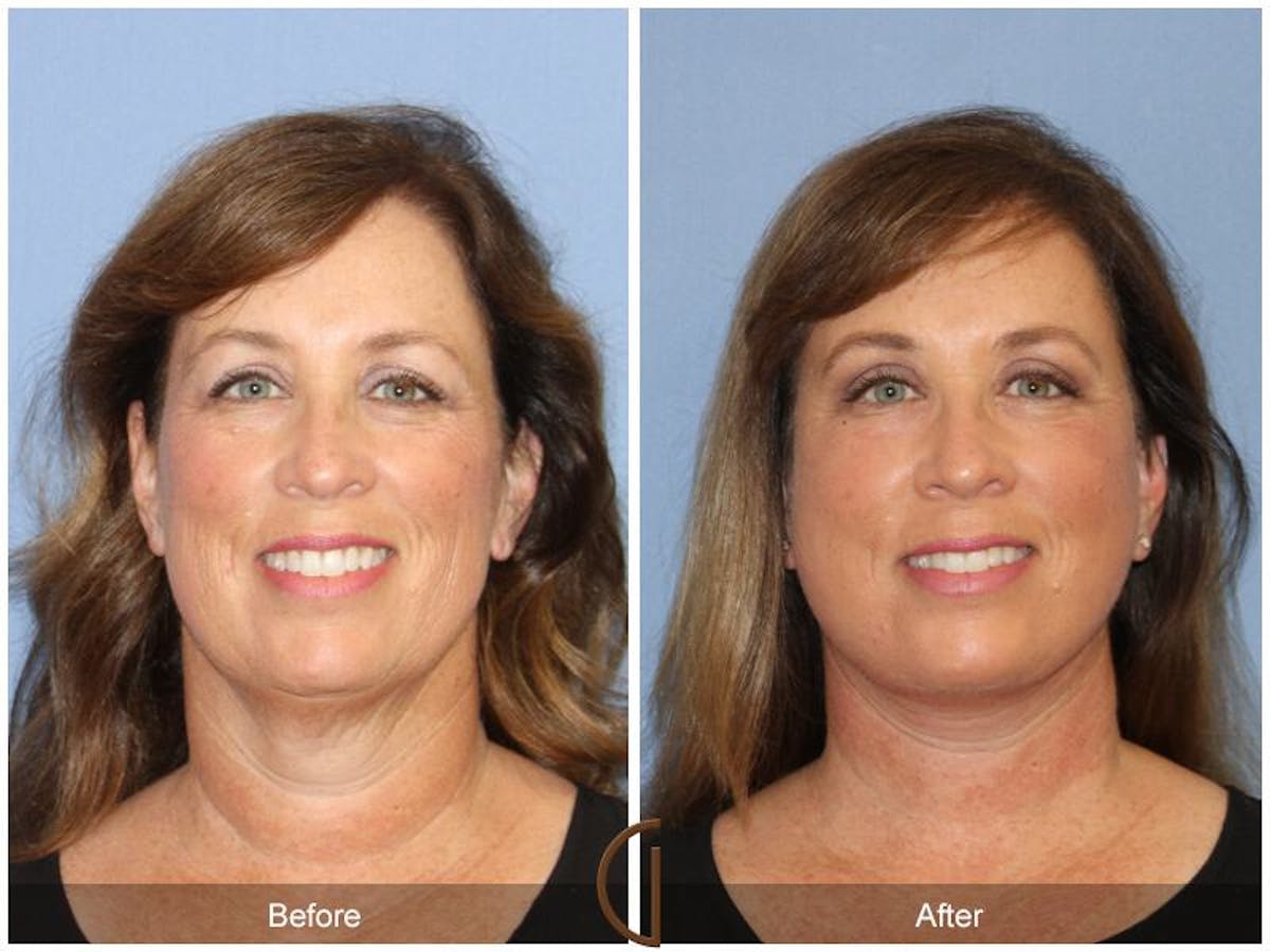 Facelift 50s Before & After Gallery - Patient 331651 - Image 2