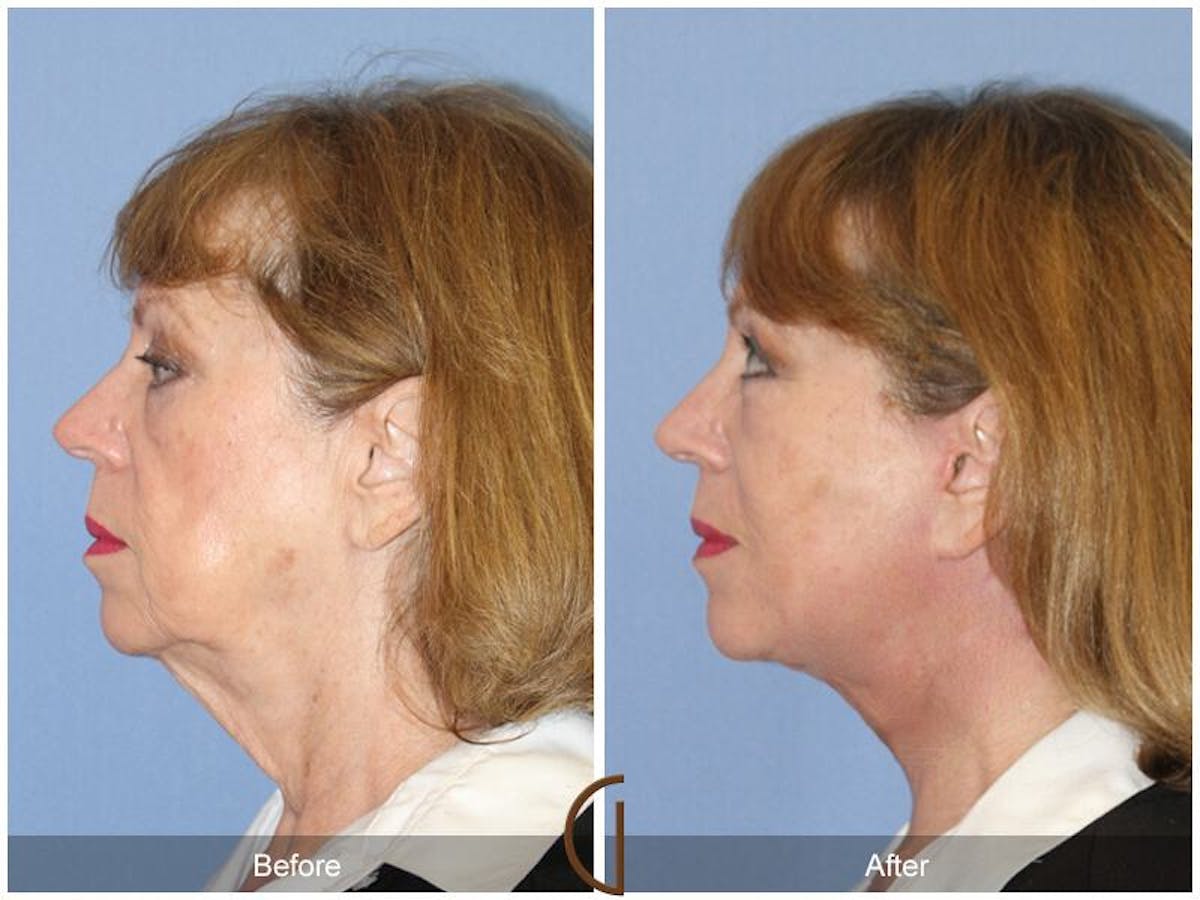 Facelift 60s Before & After Gallery - Patient 263522 - Image 1