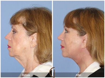 Neck Lift Before & After Gallery - Patient 374934 - Image 1