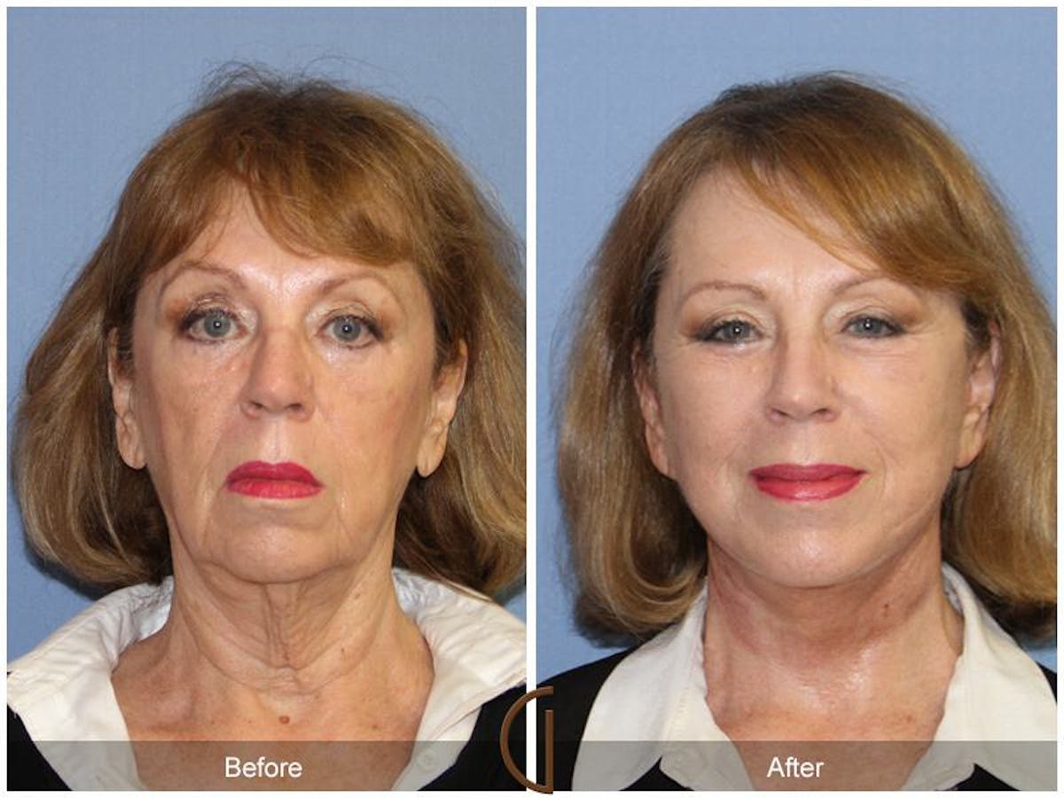 Facelift 60s Before & After Gallery - Patient 263522 - Image 2