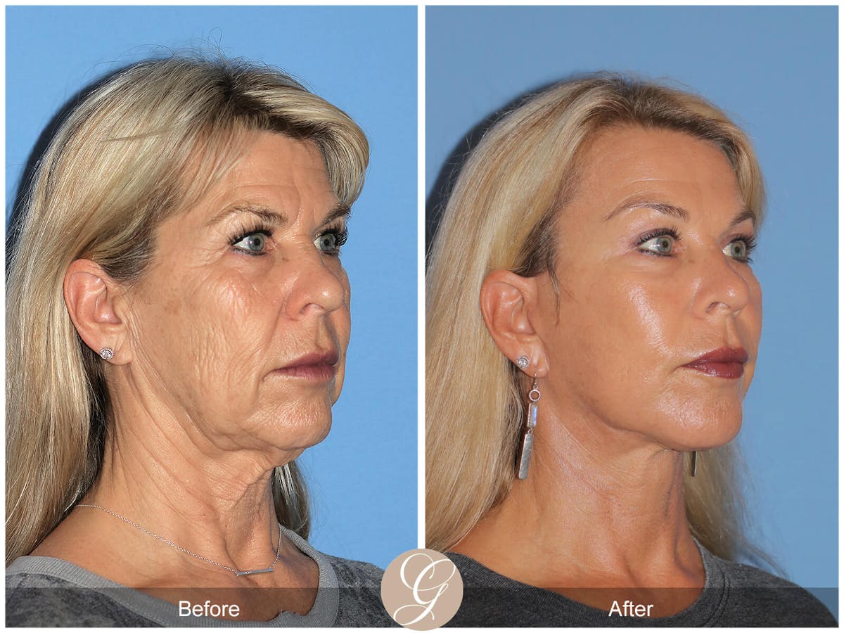 Facelift Before & After Gallery - Patient 293675 - Image 3