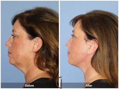 Facelift 50s Before & After Gallery - Patient 331651 - Image 1