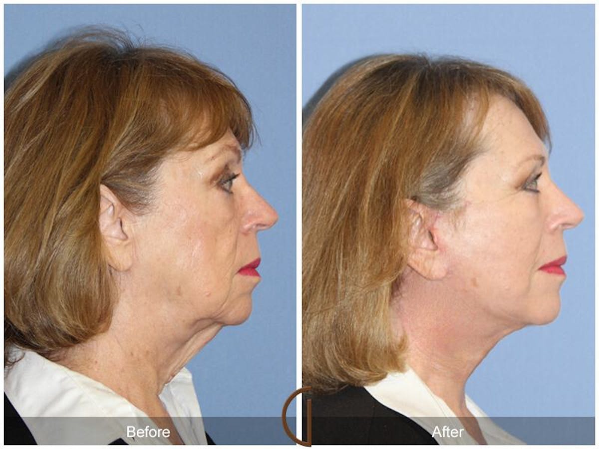 Facelift 60s Before & After Gallery - Patient 263522 - Image 3