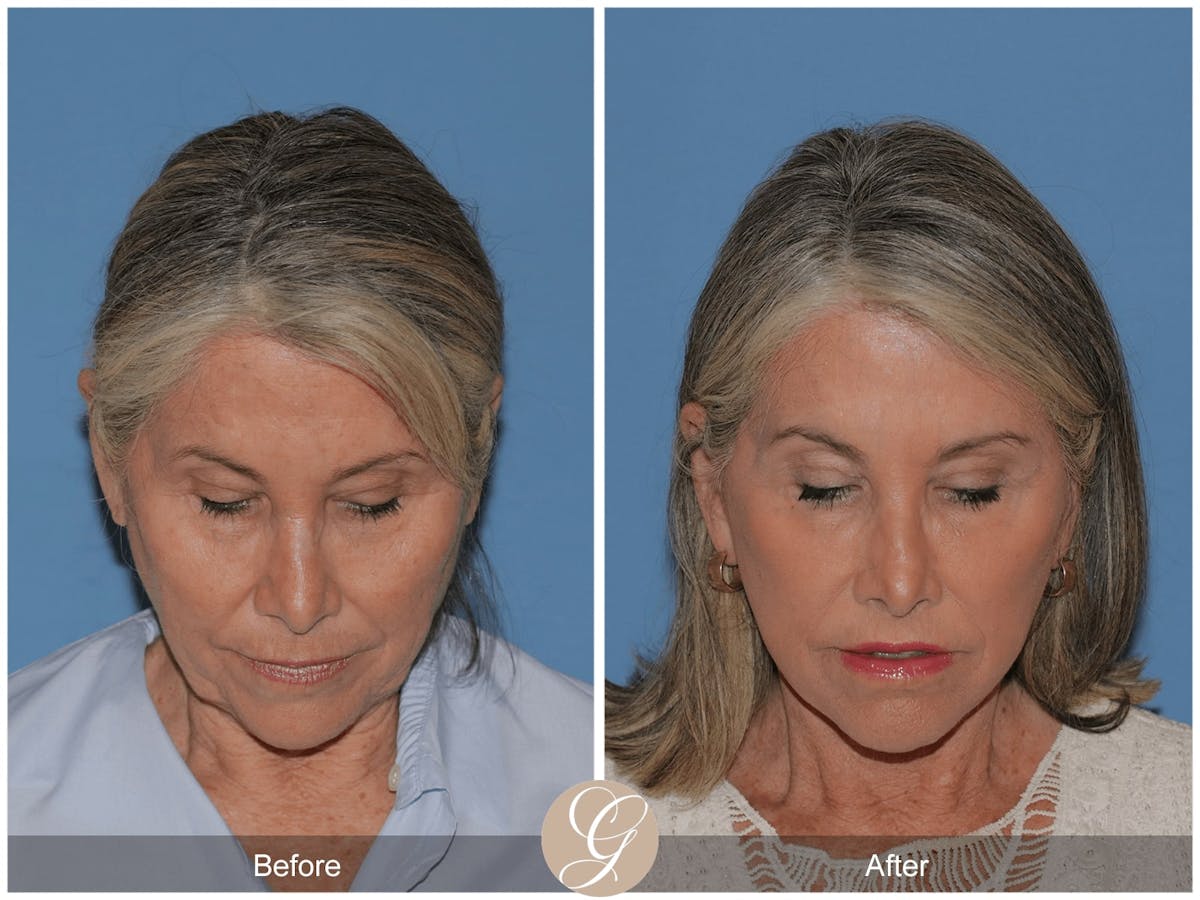 Facelift Before & After Gallery - Patient 425629 - Image 1