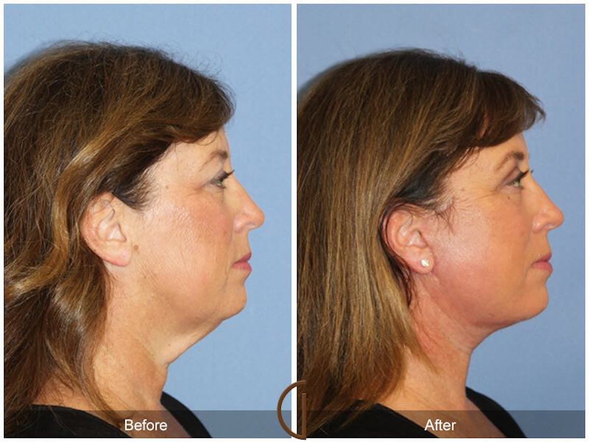 Facelift 50s Before & After Gallery - Patient 331651 - Image 3
