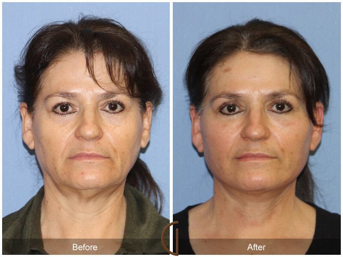 Facelift 60s Before & After Gallery - Patient 262668 - Image 2