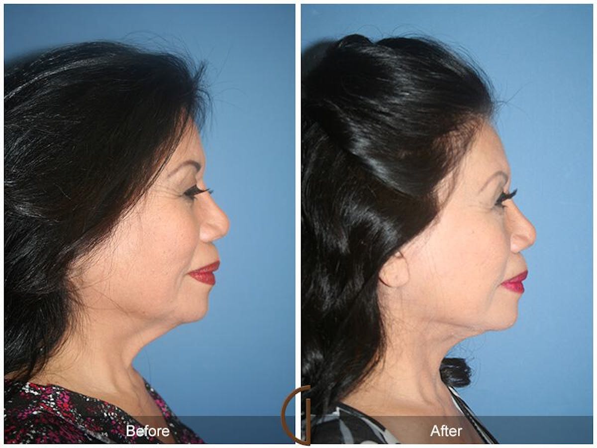Facelift 70s Before & After Gallery - Patient 312834 - Image 3