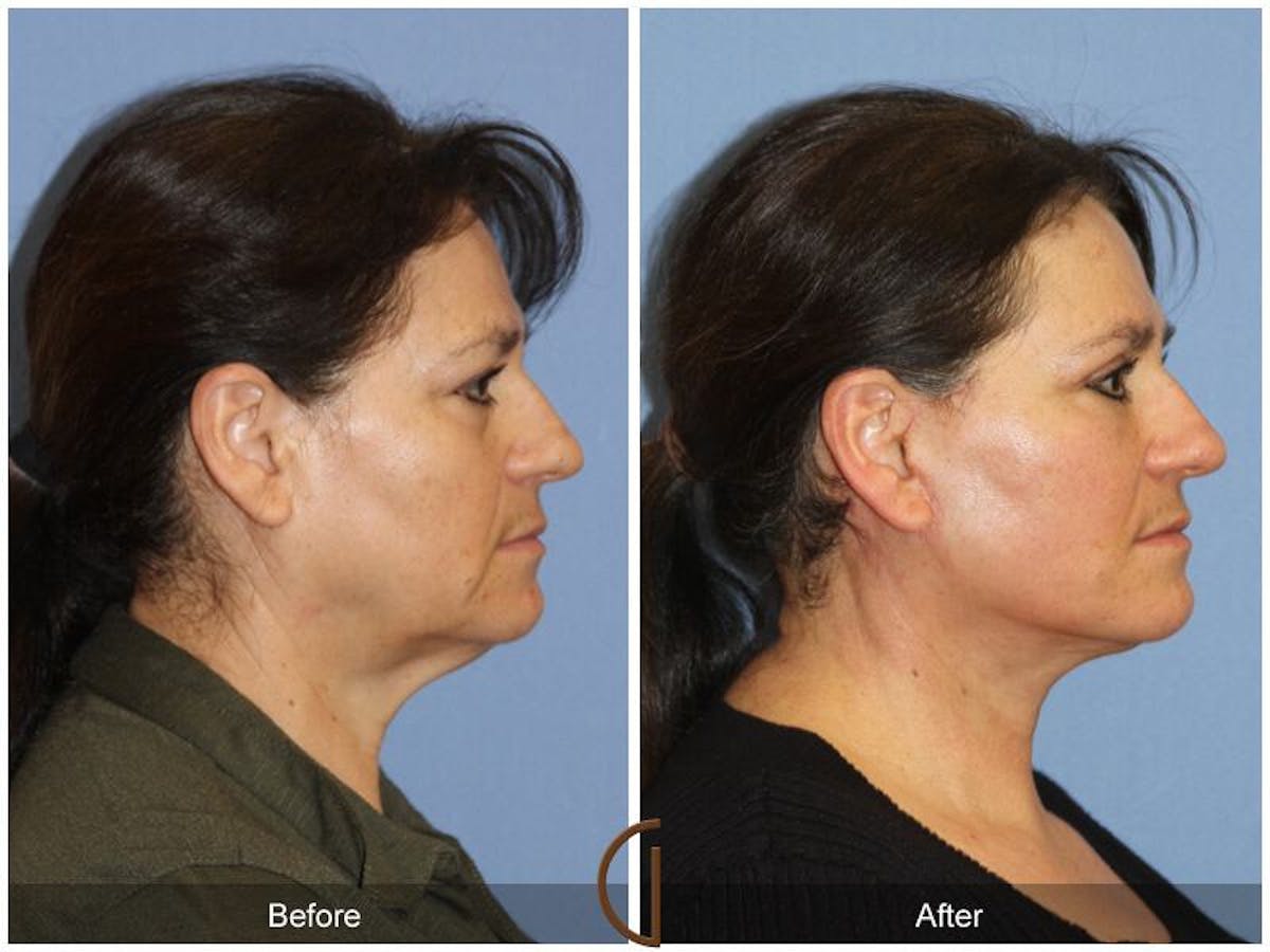 Facelift 60s Before & After Gallery - Patient 262668 - Image 3