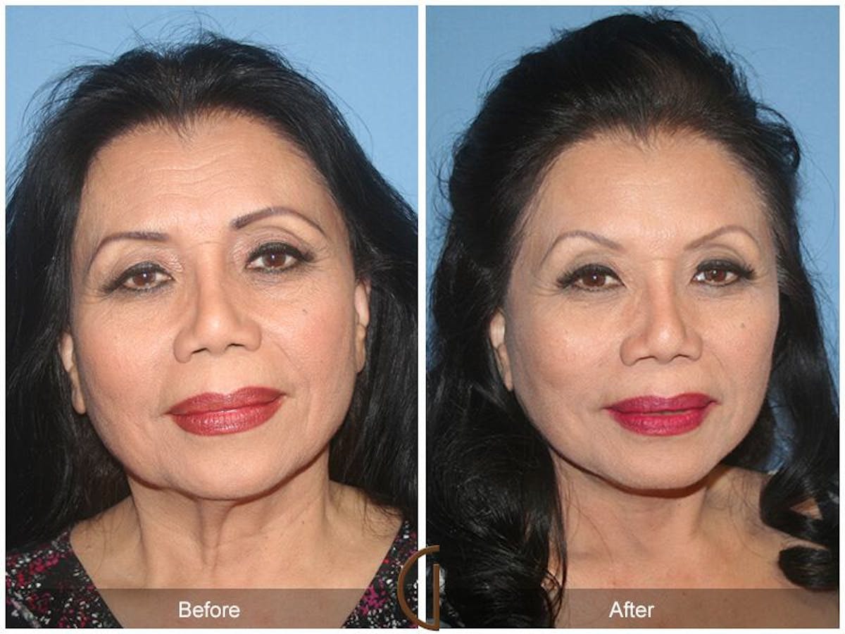 Facelift 70s Before & After Gallery - Patient 312834 - Image 2