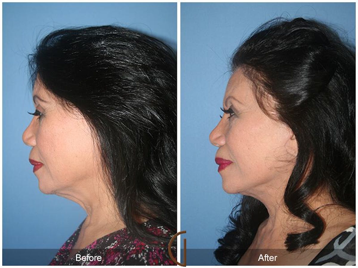 Facelift 70s Before & After Gallery - Patient 312834 - Image 1