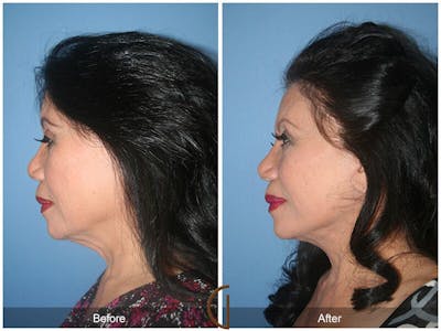 Facelift 70s Before & After Gallery - Patient 312834 - Image 1