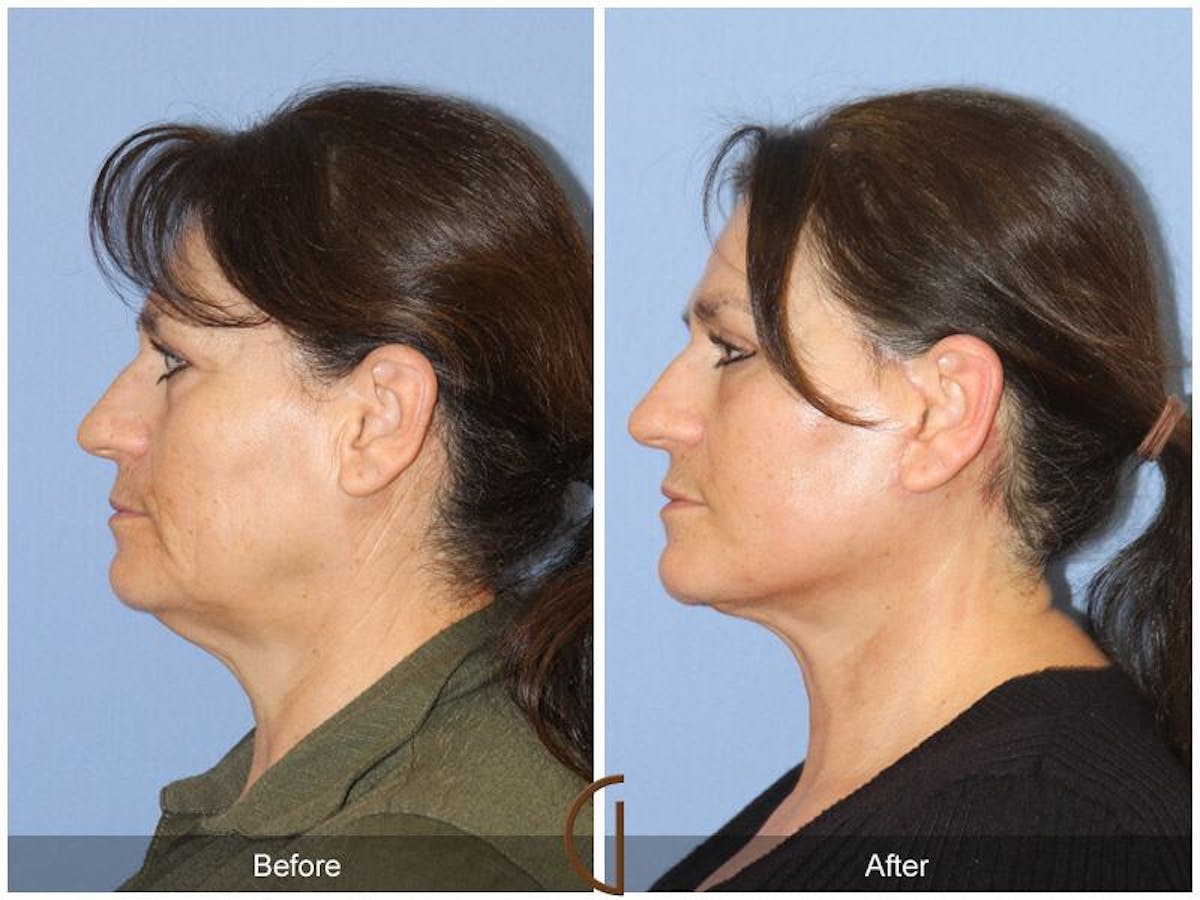 Facelift 60s Before & After Gallery - Patient 262668 - Image 1