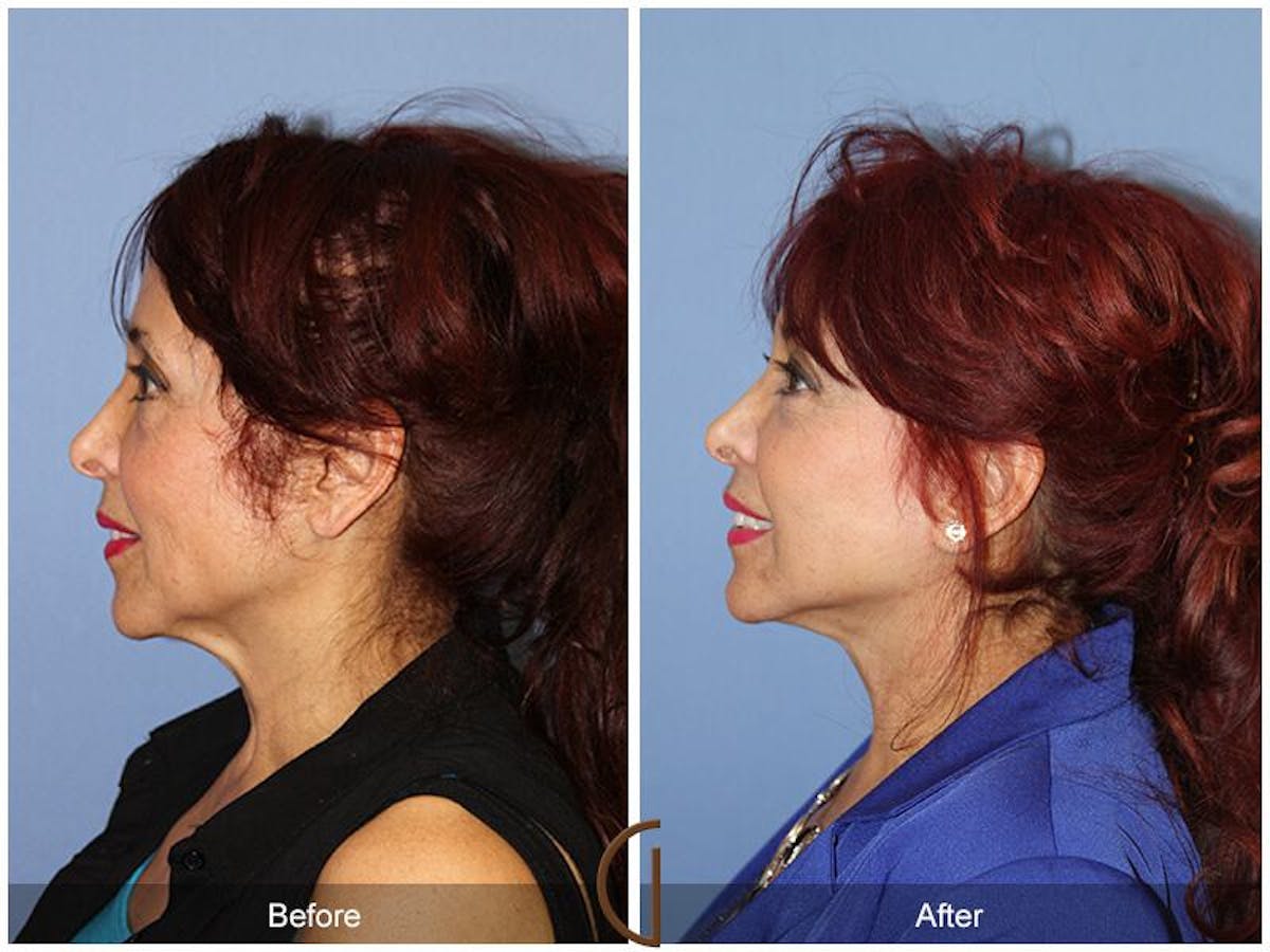Facelift 60s Before & After Gallery - Patient 408271 - Image 1