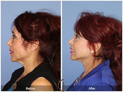Facelift 60s Before & After Gallery - Patient 408271 - Image 1