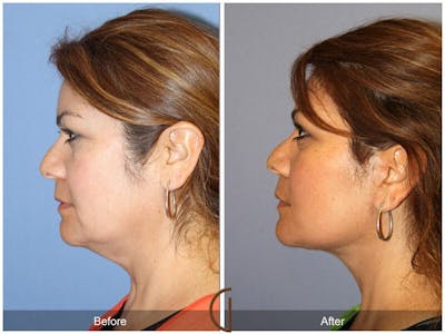 Facelift 50s Before & After Gallery - Patient 214081 - Image 1