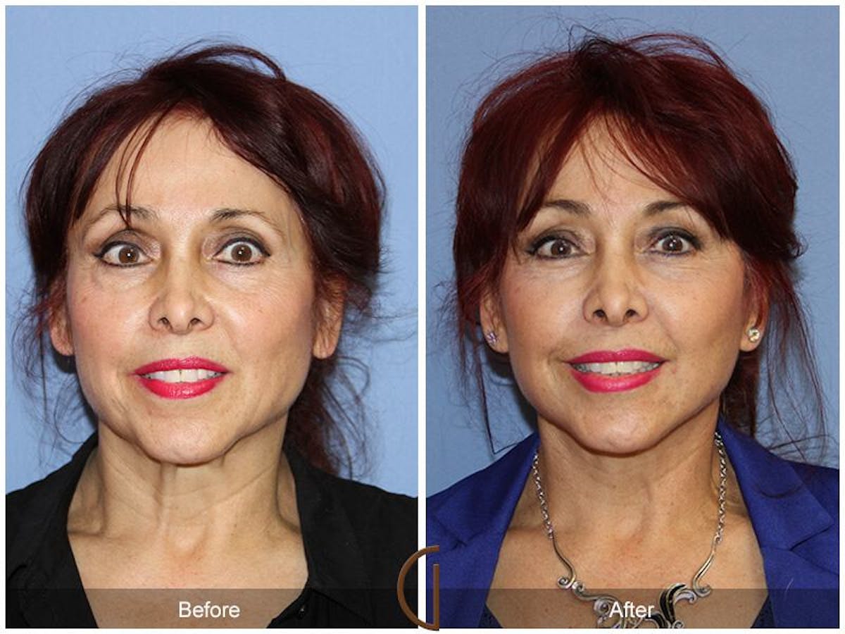 Facelift 60s Before & After Gallery - Patient 408271 - Image 2