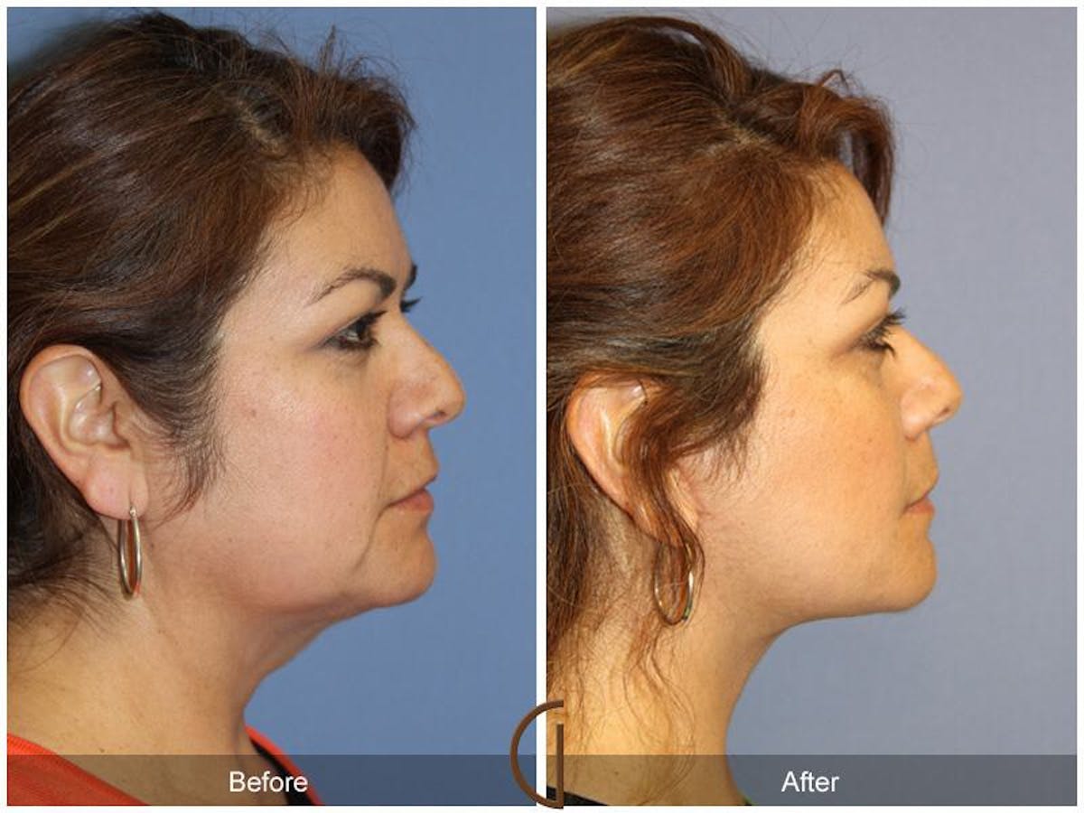 Facelift 50s Before & After Gallery - Patient 214081 - Image 3