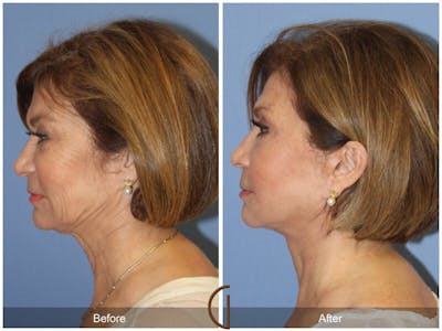 Facelift 60s Before & After Gallery - Patient 148582 - Image 1