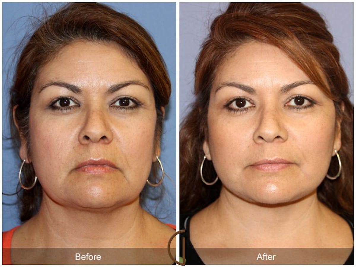 Facelift 50s Before & After Gallery - Patient 214081 - Image 2