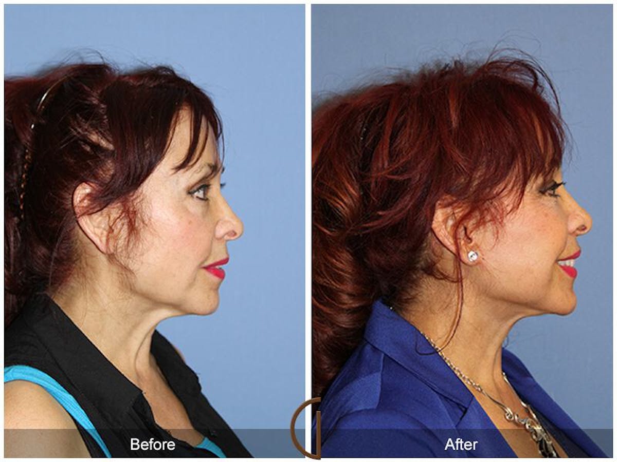 Facelift 60s Before & After Gallery - Patient 408271 - Image 3