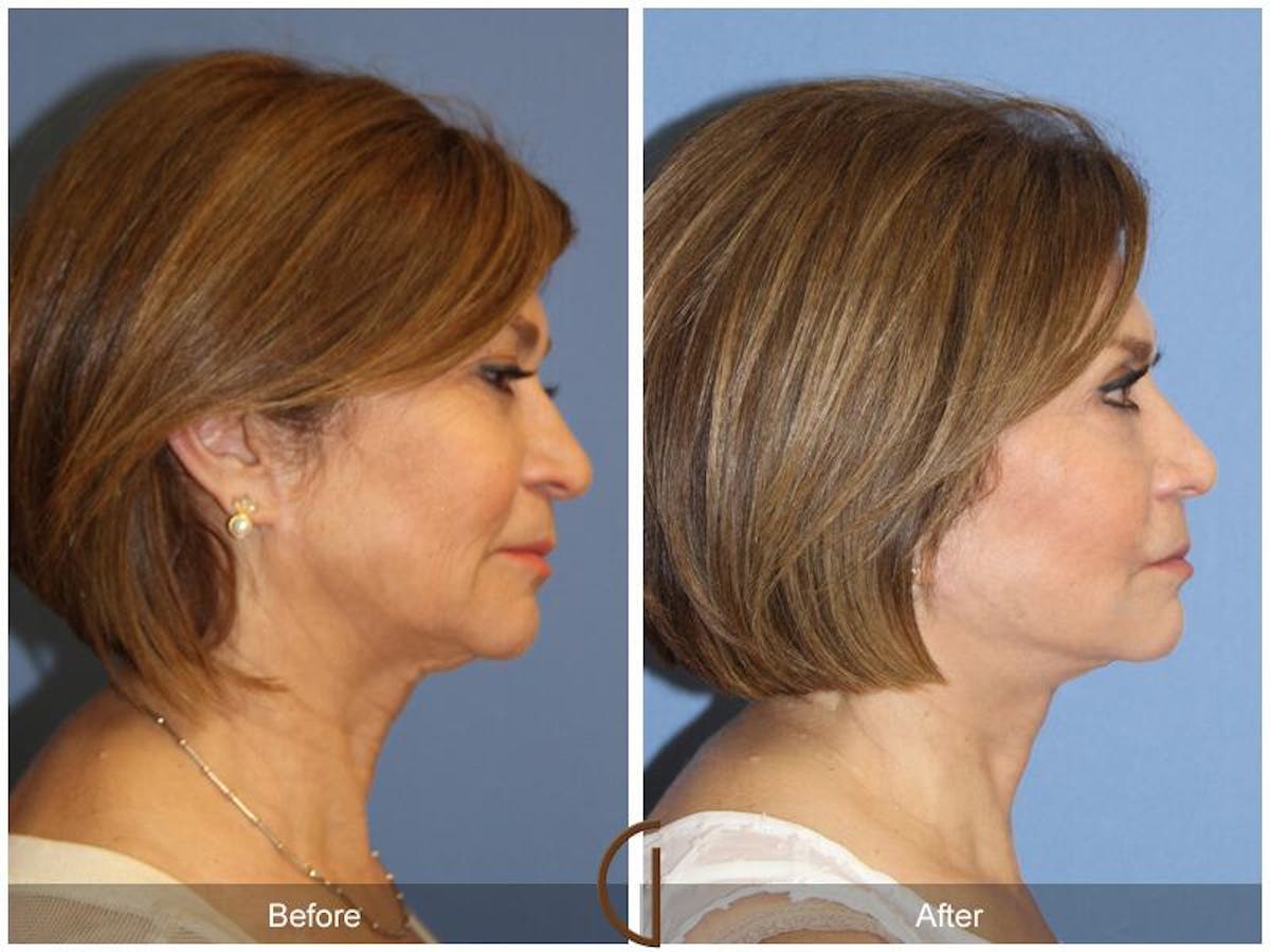 Facelift 60s Before & After Gallery - Patient 148582 - Image 3