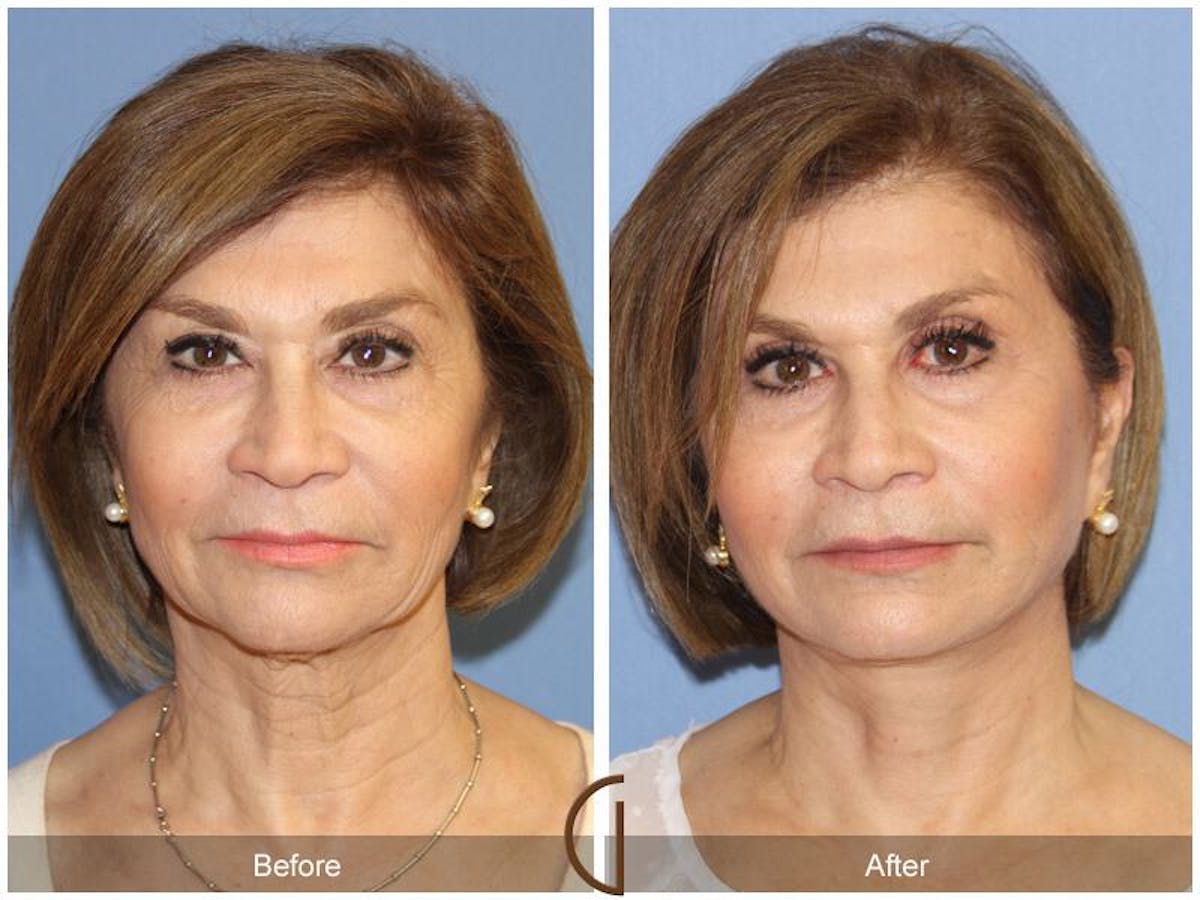 Facelift 60s Before & After Gallery - Patient 148582 - Image 2